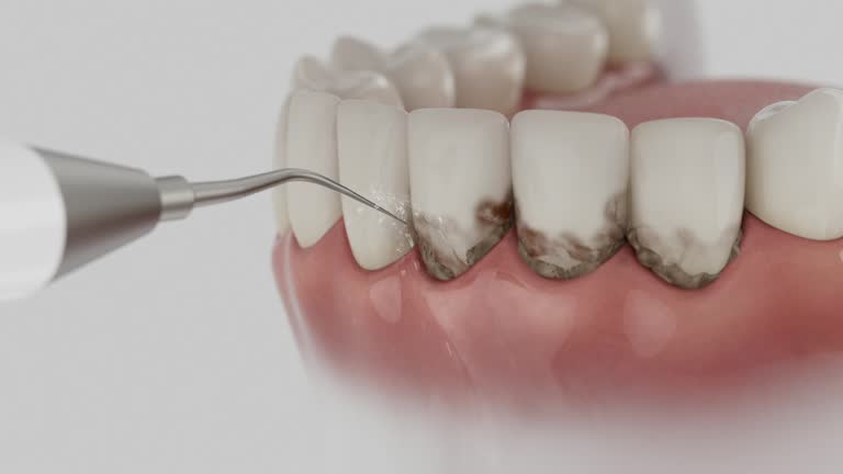 Trusted Wisdom Tooth Removal service in Vincent, CA - Dentist Open Now
